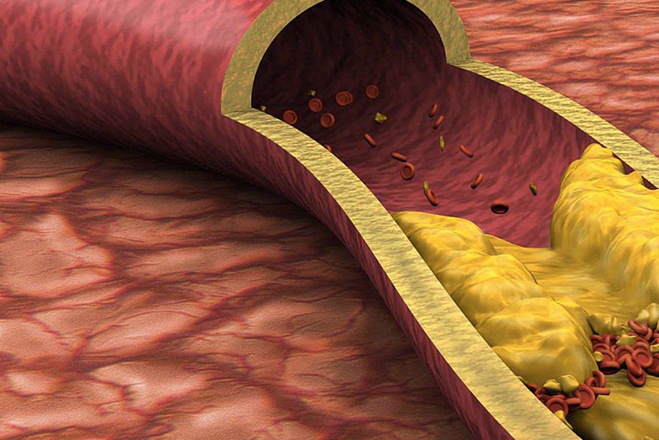 Dislipidemie: approccio dietetico per la prevenzione e la cura